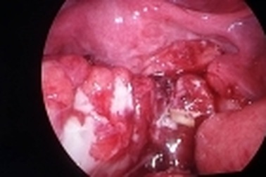 Trẻ thủng ruột do nuốt xương gà trong buổi liên hoan lớp