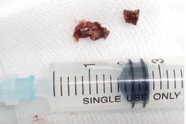 Nữ bệnh nhân "ho muốn nổ phổi" vì mảnh xương gà bỏ quên