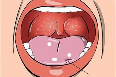 Nhiệt miệng, viêm lợi chữa mãi không khỏi – Nguyên nhân và biện pháp khắc phục hiệu quả