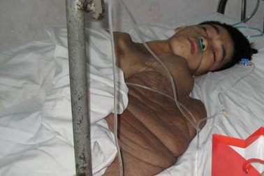 Bóc thành công 3 khối bướu khổng lồ trên lưng  “dị nhân”