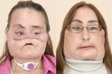 Gặp người phụ nữ đầu tiên được ghép mặt ở Mỹ