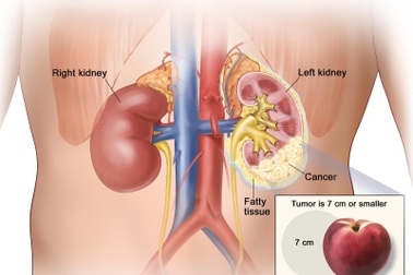 Các triệu chứng hiếm gặp của ung thư thận