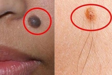 Nốt ruồi có tiến triển thành ung thư?