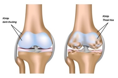 Thoái hóa khớp và giải pháp điều trị hiệu quả