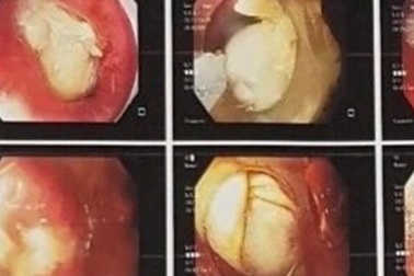 Người phụ nữ tử vong sau hóc thịt trâu 5 ngày
