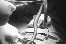 Phát hiện con lươn dài 30cm trong ổ bụng người đàn ông