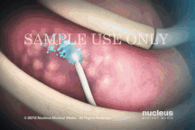 Phương pháp hóa trị liệu tiêu diệt tế bào ung thư như thế nào?