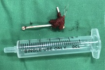 Suốt ngày bị đau hạ vị do vòng tránh thai đi lạc vào bàng quang