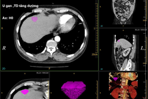 Thanh niên 28 tuổi bị ung thư gan và lời cảnh tỉnh cho những người thích rượu