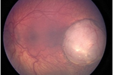 Cảnh giác khi mắt bé có ánh đồng tử trắng "mắt mèo" bất thường