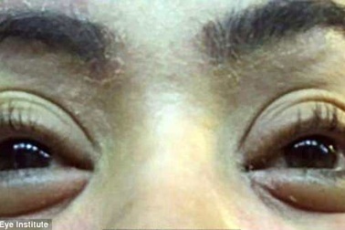 Nối mi, 12 phụ nữ bị bọ ve bám trên mí mắt