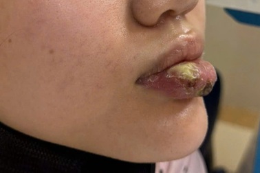 Tiêm “giải filler” tại spa không phép, cô gái trẻ bị ổ áp xe lớn ở môi