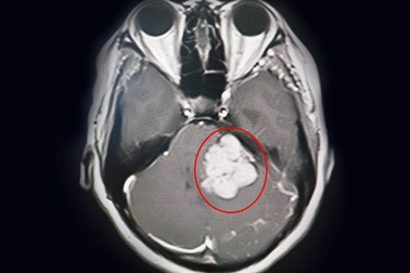 Đau đầu, mất thính lực vì khối u như quả trứng trong não