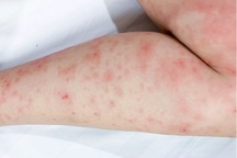 Mưa lớn kéo dài nhiều ngày, hàng ngàn người ở TPHCM đi khám bệnh da liễu