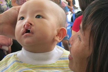 Phẫu thuật miễn phí cho trẻ sứt môi, hở hàm ếch