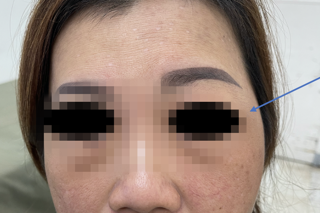 Bí ẩn nhiều người phải mổ não, mất mạng vì hoại tử xương sọ hậu Covid-19 - 1 Bí ẩn nhiều người phải mổ não, mất mạng vì hoại tử xương sọ hậu Covid-19 - 1