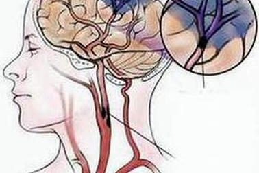 Cảnh giác đột quỵ ở người bệnh tiểu đường, huyết áp, rung nhĩ