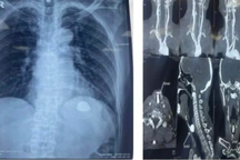 Đang chăm hoa, người đàn ông Hà Nội bỗng bị viên sỏi lọt vào đường thở