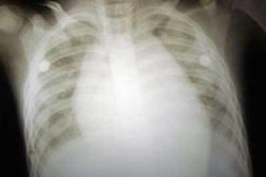 Cứu sống bệnh nhi có màng tim phồng như “quả bầu”