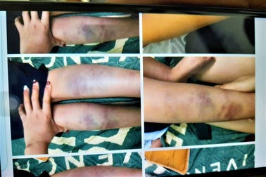 Vụ học sinh bầm tím chân: Cô giáo tạm thời không đứng lớp