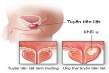 3 xét nghiệm cần làm để chẩn đoán ung thư tiền liệt tuyến