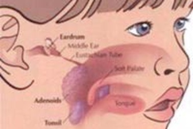 Viêm họng cấp: Triệu chứng và cách điều trị