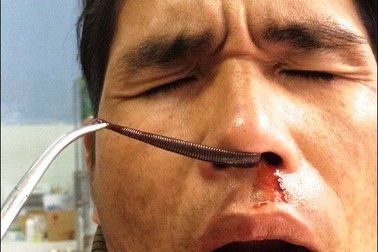 Uống nước suối bị đỉa dài 5 cm chui vào mũi