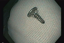 Chiếc đinh ốc vít chui tọt vào dạ dày bé trai