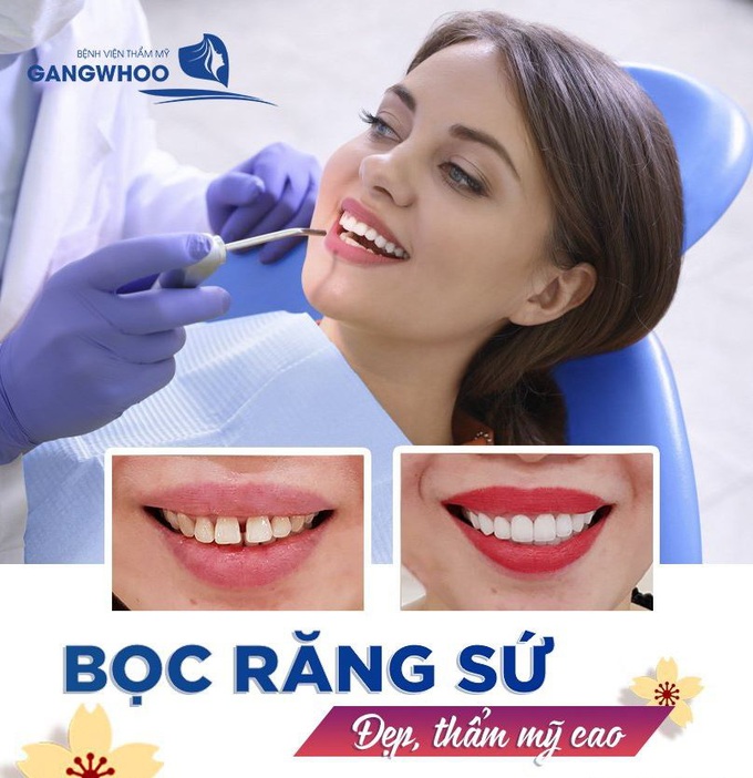 Hơn 98% khách hàng "Cười tươi không cần tưới" sau khi bọc răng sứ tại bệnh viện thẩm mỹ Gangwhoo - Ảnh 2. Hơn 98% khách hàng "Cười tươi không cần tưới" sau khi bọc răng sứ tại bệnh viện thẩm mỹ Gangwhoo - Ảnh 2.