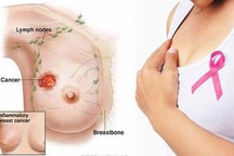 Cảnh giác hạch ở nách có thể báo hiệu ung thư vú