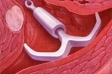 Những lưu ý khi đặt vòng tránh thai