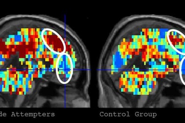 Đánh giá nguy cơ tự tử qua phản ứng của não với từ ngữ