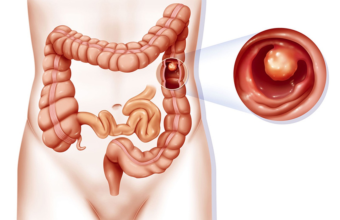 Phòng ngừa ung thư khi có polyp đại tràng như thế nào? - 1 Phòng ngừa ung thư khi có polyp đại tràng như thế nào? - 1