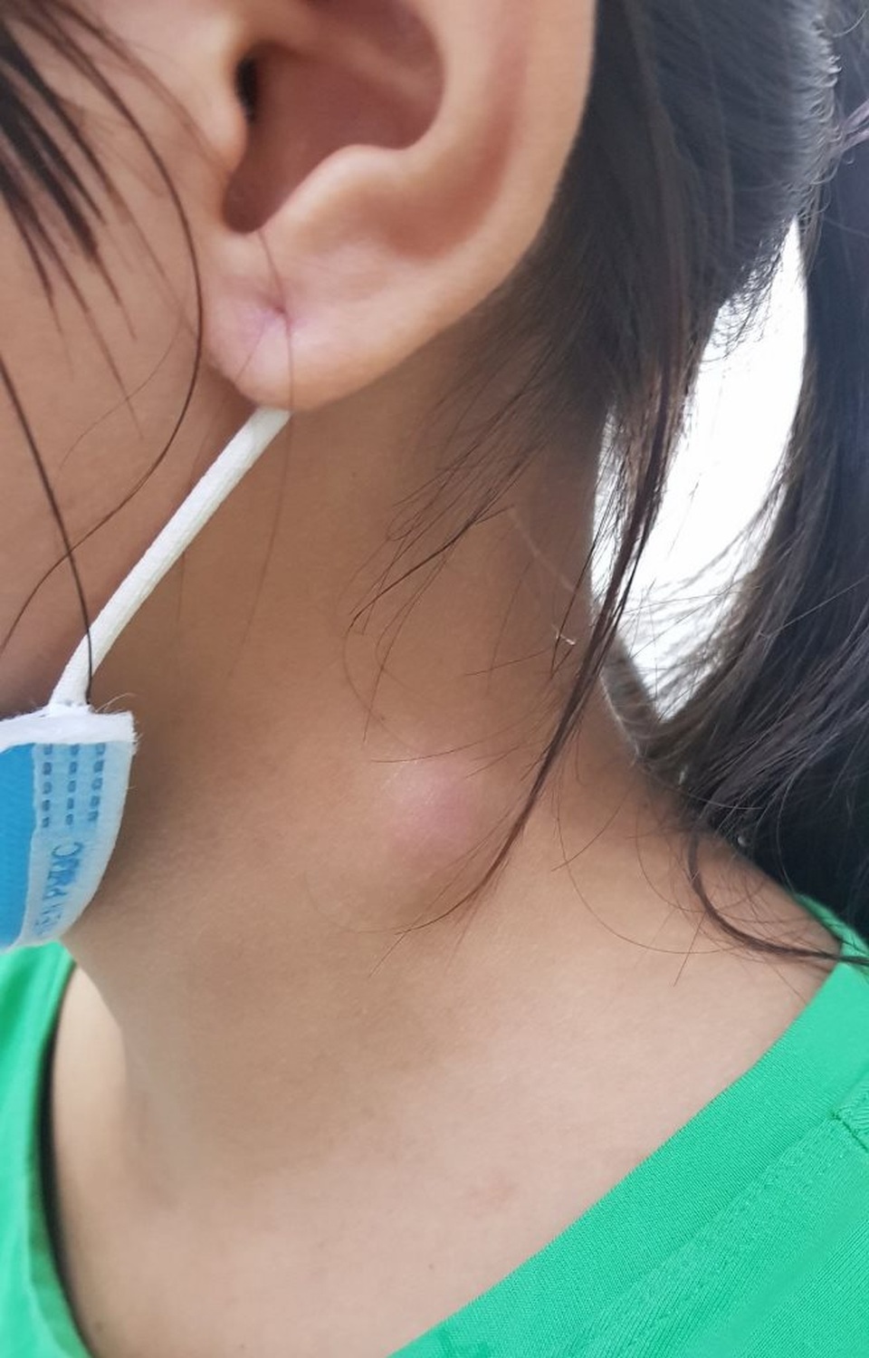 Mắc xương cá điều trị theo phương pháp dân gian, bé gái bị sưng vùng cổ - 1 Mắc xương cá điều trị theo phương pháp dân gian, bé gái bị sưng vùng cổ - 1