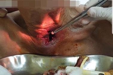 Hơn 30 con giòi làm tổ trong họng cụ ông ở Quảng Ninh