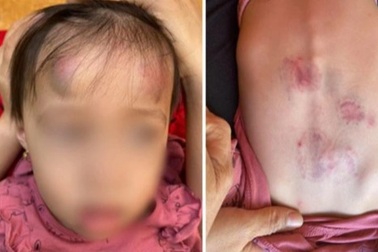Bé gái mầm non bị bạn đánh, đạp thâm tím tại lớp, cô giáo không biết