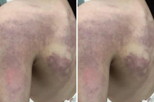 Học sinh lớp 3 nghi bị cô giáo đánh bầm tím người vì không làm được bài