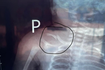 Làm rõ nguyên nhân bé gái 4 ngày tuổi bị gãy xương bả vai