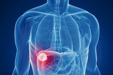 Ung thư gan được điều trị bằng những phương pháp nào?