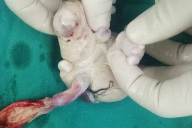 Bé trai 4 tháng tuổi… mang thai nặng 1,5kg