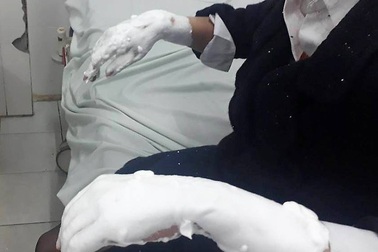 Chùm bóng bay phát nổ vì bắt lửa tàn thuốc, 3 sinh viên bị bỏng