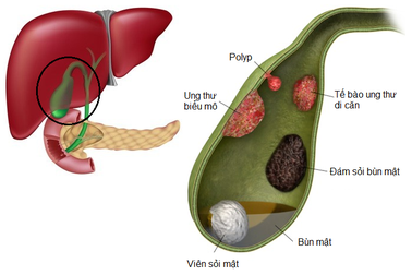 Polyp túi mật: Hiểu để điều trị đúng cách