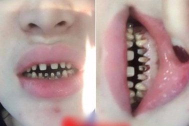 Bọc răng sứ thẩm mĩ và những hiểu lầm tai hại cần biết!