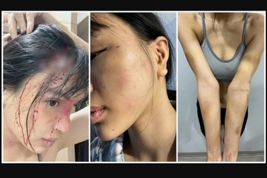 Siêu mẫu nghi bị bạo hành dã man: "Khi yêu thương kết thúc bằng… nắm đấm"?