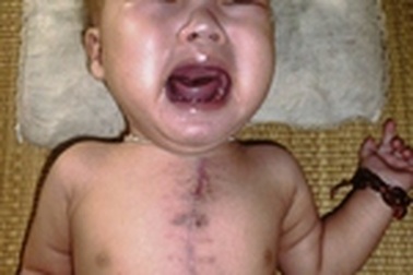 Mắc bệnh tim bẩm sinh phức tạp, sự sống bé 9 tháng tuổi hết sức mong manh 