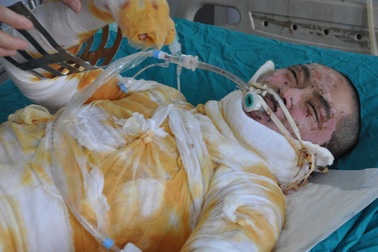 Chàng trai 18 tuổi bỏng nặng vì nướng cá bằng cồn