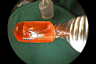 Bóng đèn nhựa nằm trong phổi bé gái 10 tháng tuổi