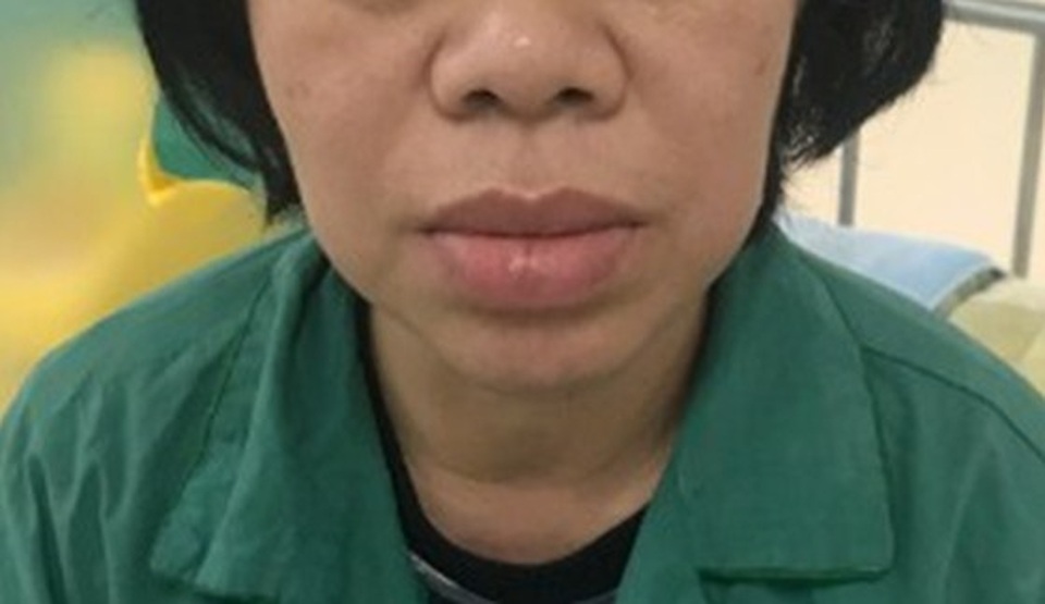Tưởng phát tướng vì tay chân to, mũi nở, không ngờ bệnh nguy hiểm - 2 Tưởng phát tướng vì tay chân to, mũi nở, không ngờ bệnh nguy hiểm - 2
