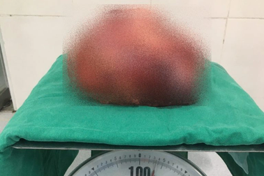 Khối u to như quả bóng trong bụng vì chủ quan không đi khám