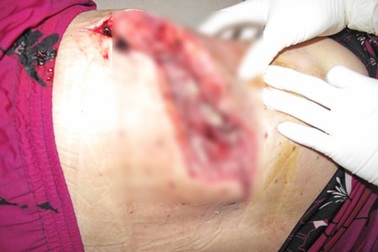 Nguy kịch vì cắt lễ thiếu vệ sinh